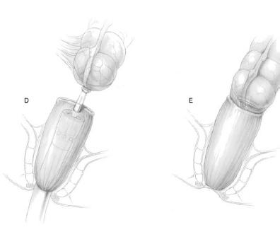anastomosi dopo resezione del colon