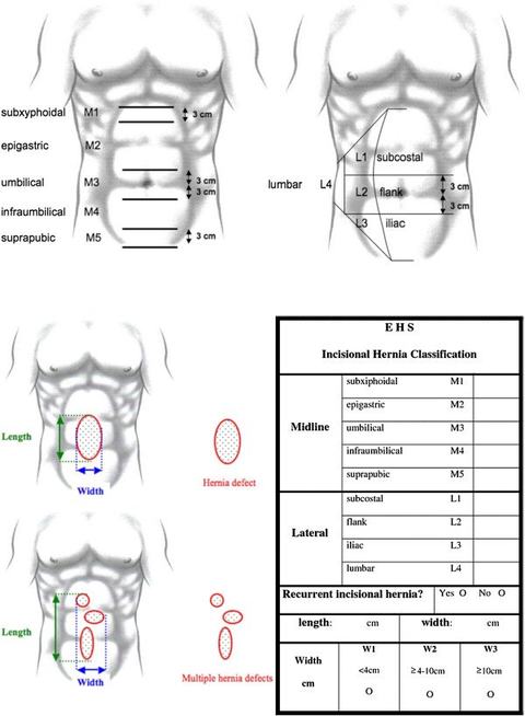 classificazione EHS (European Hernia Society)