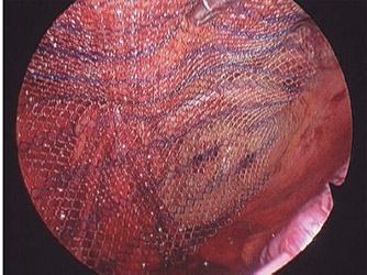 posizionamento della mesh a copertura di tutti gli orifizi