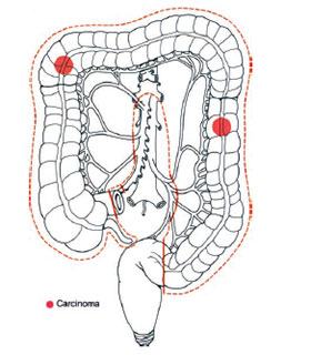 colectomia totale/subtotale per lesioni sincrone multifocali