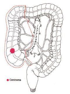 Emicolectomia destra per lesione del colon destro